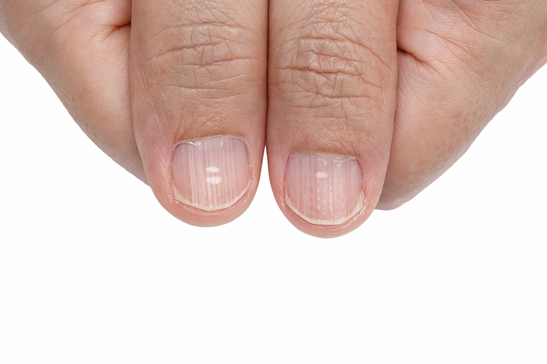 taches blanches sur les ongles des mains