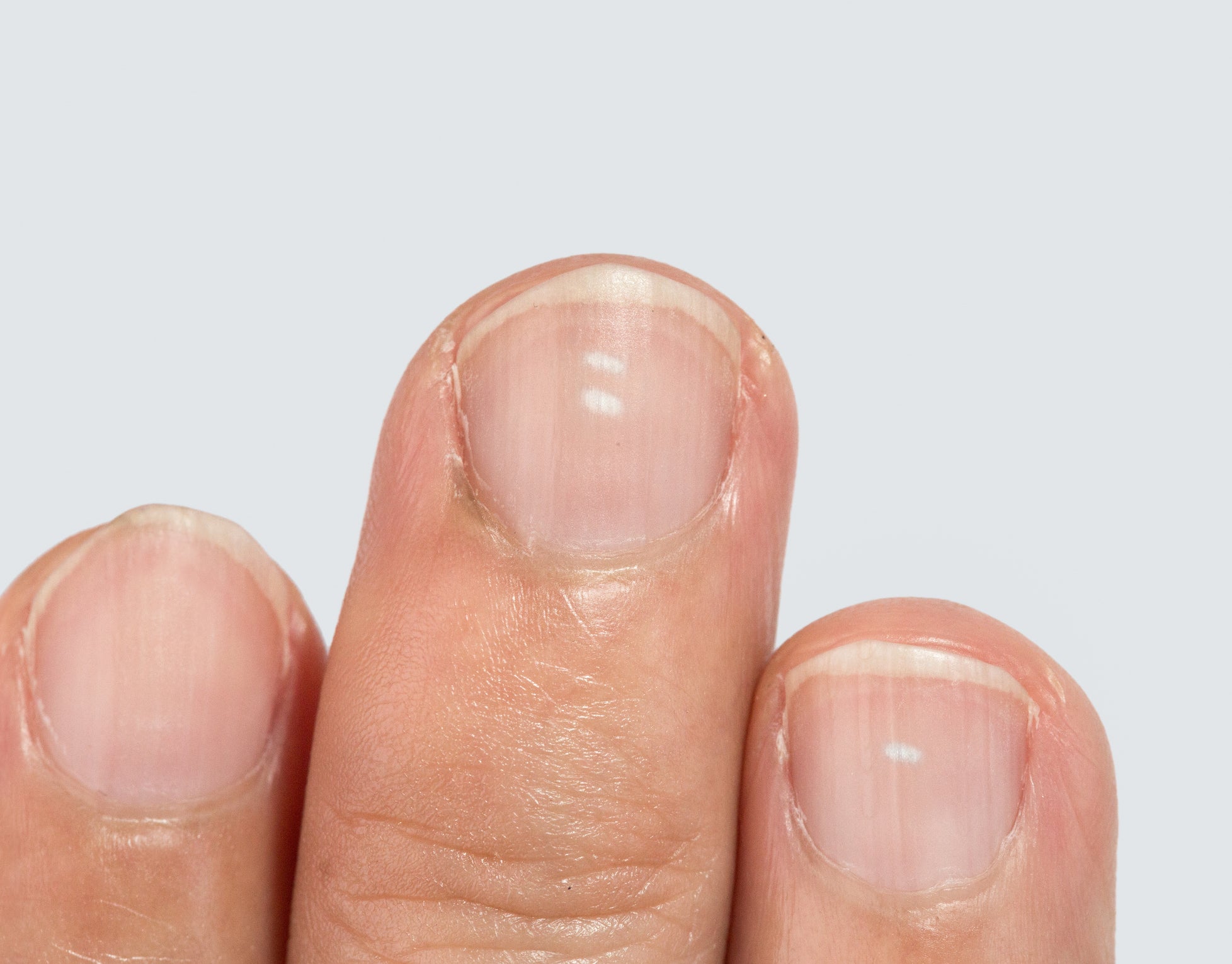 Diagnostic des taches blanches sur les ongles