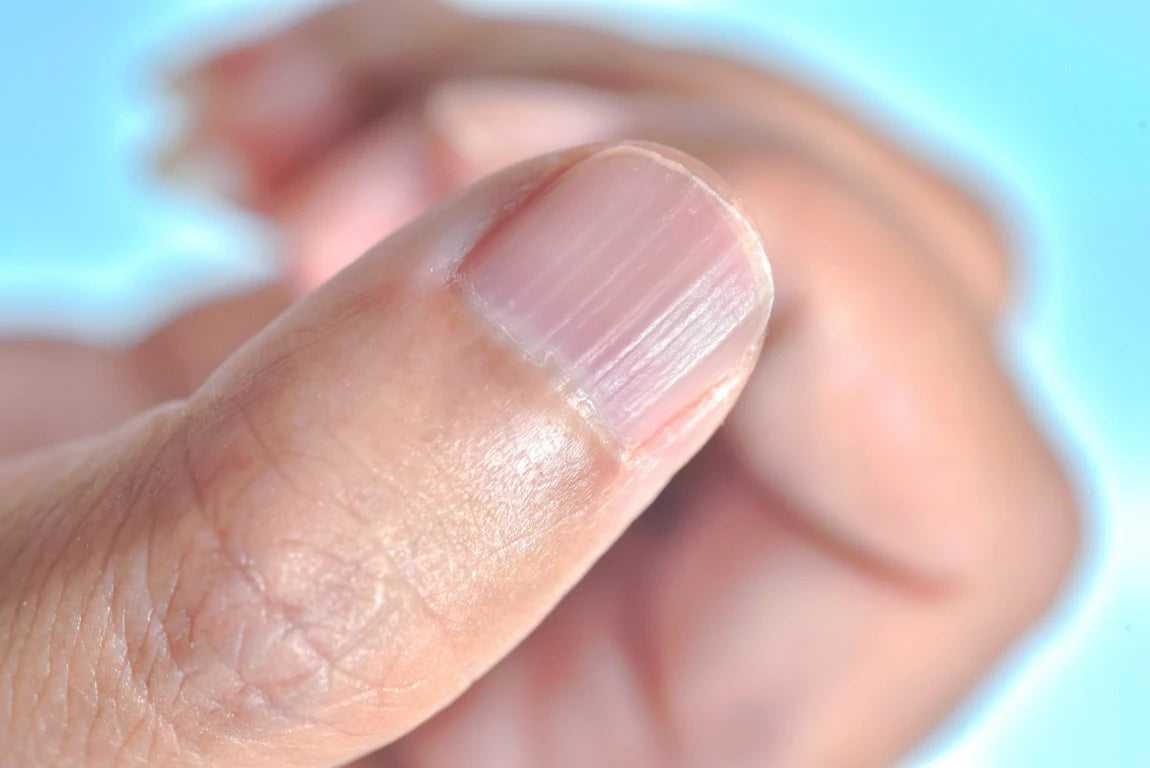 Stries sur un ongle de doigt, signe de problèmes de santé ou de carences.