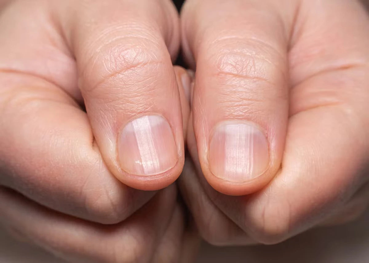 Stries sur les ongles, leurs causes et traitements pour une meilleure santé des ongles.