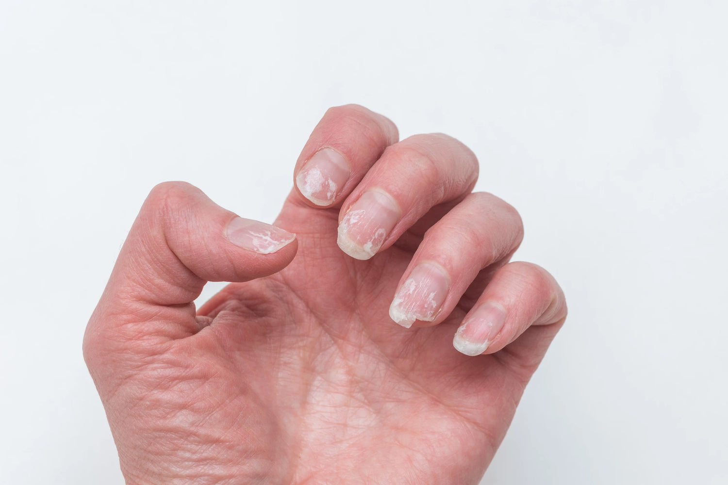 les causes des ongles abîmés et ce qu'il faut faire